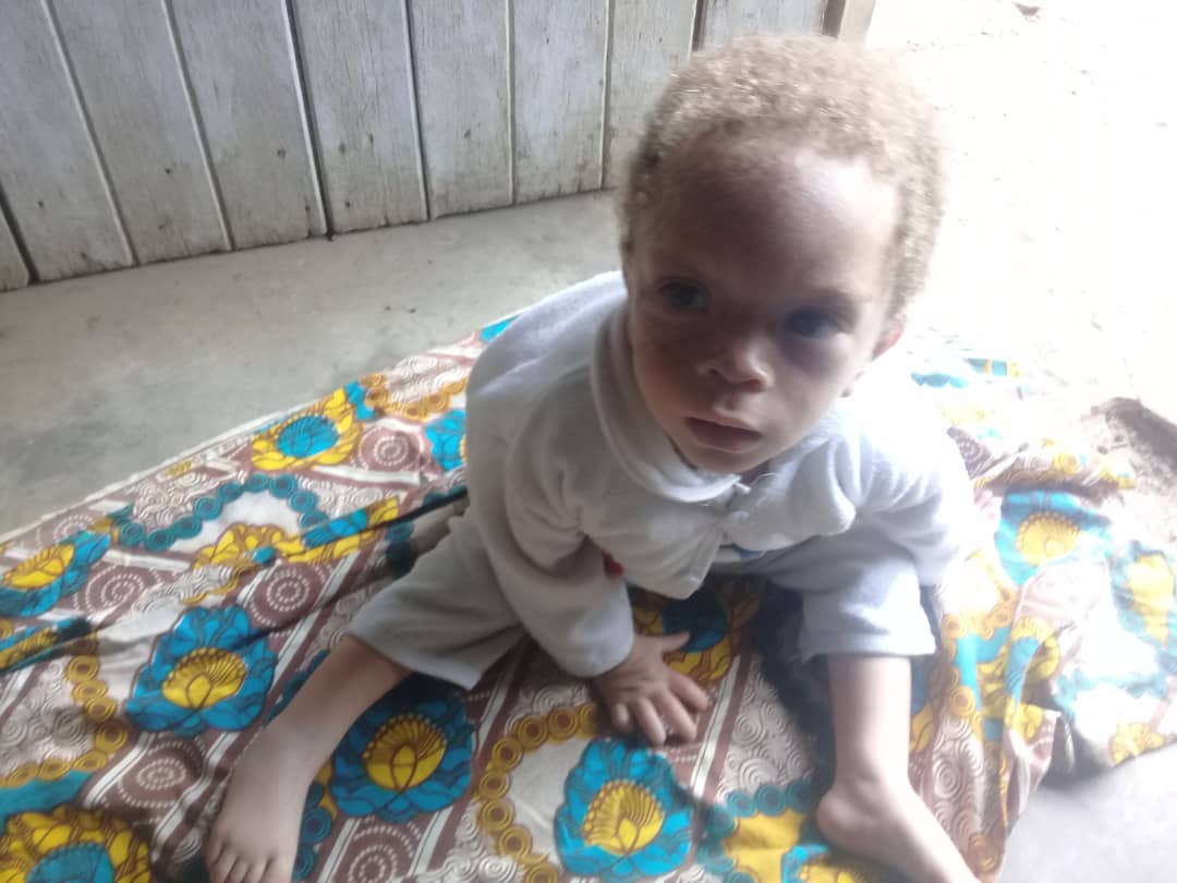 The Albino Child Sponsorship Program