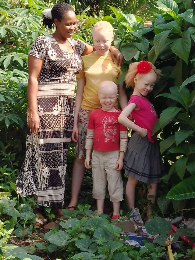 The adversity of raising children with albinism in Uganda