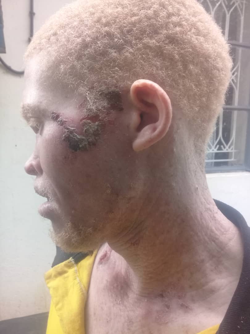 Skin cancer continues to terrorize the lives of people with albinism in Uganda